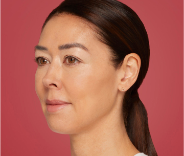 A Restylane® Contour patient after receiving treatment 